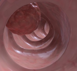 Cyst hasi lép, gyomor, epehólyag, belek, a tünetek és a kezelés (hasi ciszta) Cyst hasi lép, gyomor, epehólyag, belek, tünetek és a kezelés