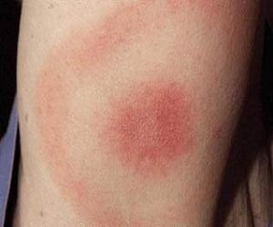 Кільцеподібна еритема шкіри перші ознаки і лікування захворювання