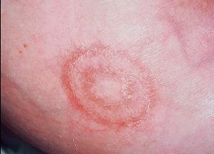 Кільцеподібна еритема шкіри перші ознаки і лікування захворювання