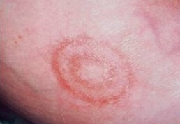 A gyűrű alakú bőrpír - Kezelés, okai, tünetei