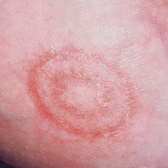 A gyűrű alakú bőrpír - Kezelés, tünetei, okai