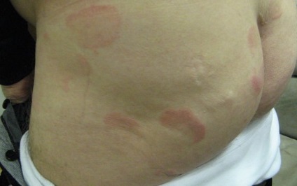 A gyűrű alakú bőrpír - okai, tünetei és kezelése