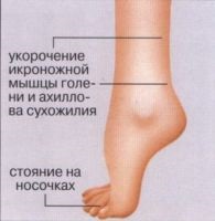 A lábszár üreges kezelése. Színpad deformációja