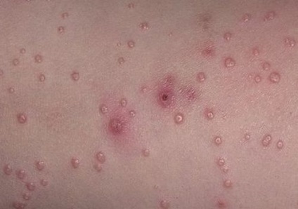 Molluscum contagiosum az arcon (század, áll) - Tünetek és kezelés