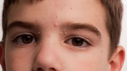 Molluscum contagiosum az arcon (század, áll) - Tünetek és kezelés