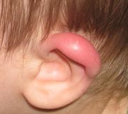 Red fül egy gyermek okoz bőrpírt és a gyulladást, orvoshoz