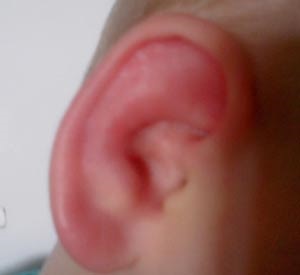 Red fül egy gyermek okoz bőrpírt és a gyulladást, orvoshoz