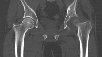 hip Km ár spirál CT és CT, MRI