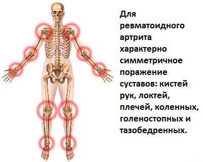 Fizioterápia egy súlyosbodását arthritis - ez egy beteg keze