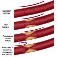 lézeres kezelés az atherosclerosis, lézeres érplasztika