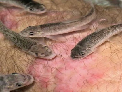 Psoriasis kezelése hal Garra Rufa - jellemzői és eljárás hatékonyságát