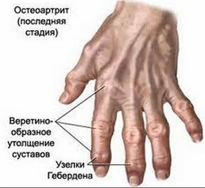 Az ízületek kezelési az ujjak és a betegség megelőzése