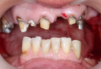 Mini implantátumok fogak - ár, szakértői értékelés, az élettartam!