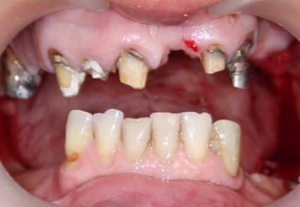 Mini implantátumok fogak - ár, szakértői értékelés, az élettartam! (Időszak) Mini implantátumok fogak - ár, szakértői értékelés, az élettartam!