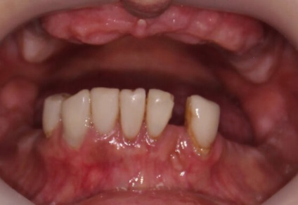 Mini implantátumok fogak - ár, szakértői értékelés, az élettartam! (Review) Mini implantátumok fogak - ár, szakértői értékelés, az élettartam!