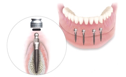 Mini implantátumok fogak - ár, szakértői értékelés, az élettartam! (Rögzítése) Mini implantátumok fogak - ár, szakértői értékelés, az élettartam!