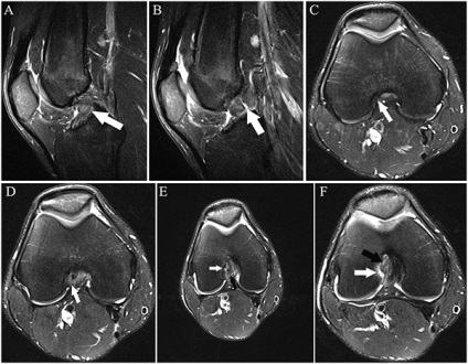 MRI a térd, amely megmutatja ultrahangos képalkotás és a betegségek a térdízület