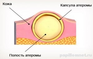 Gennyes atheroma - kezelés, a tünetek és a megelőzés az oktatás