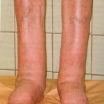 Népi jogorvoslati kezelésére elephantiasis láb - orvosával Aibolit
