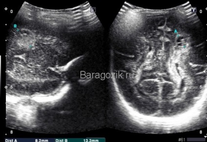 Neurosonography olvasás, dekódolás, a szabványok, a patológia (neurosonography átirat) Neurosonography olvasás, dekódolás, normák, patológia