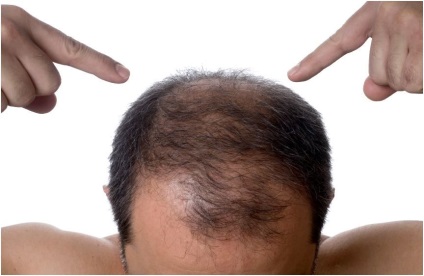 Hírek a növények (Hair Restoration férfiak) Hírek a növények