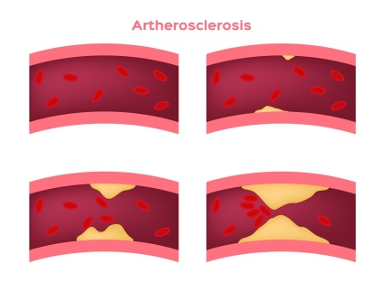 Atherosclerosis okoz alsó végtagok, a kezelés