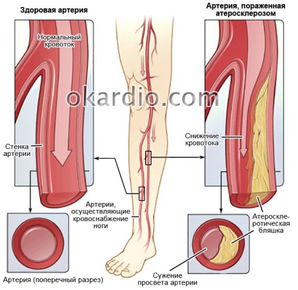 Olvashatatlanná atherosclerosis az alsó végtagok tünetek és kezelés (obliterans) Olvashatatlanná atherosclerosis az alsó végtagok tünetek és kezelés