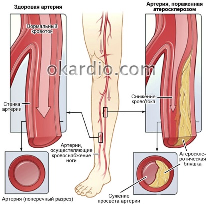 Olvashatatlanná atherosclerosis az alsó végtagok tünetek és kezelés