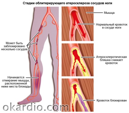 Olvashatatlanná atherosclerosis az alsó végtagok tünetek és kezelés (hajók) Olvashatatlanná atherosclerosis az alsó végtagok tünetek és kezelés
