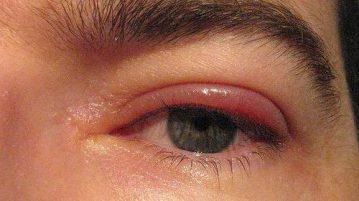 Piros szemhéjak újszülöttben: okok, következmények, kezelés