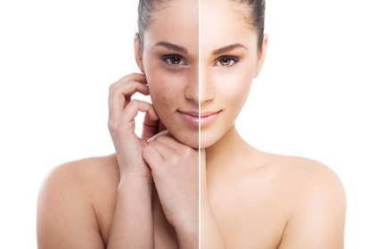 Felületi kémiai peeling arc véleménye, fotók előtt és után (a személy) Felületi kémiai peeling arc véleménye, fotók előtt és után