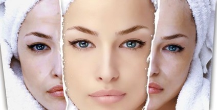Felületi kémiai peeling arc véleménye, fotók előtt és után (a személy) Felületi kémiai peeling arc véleménye, fotók előtt és után