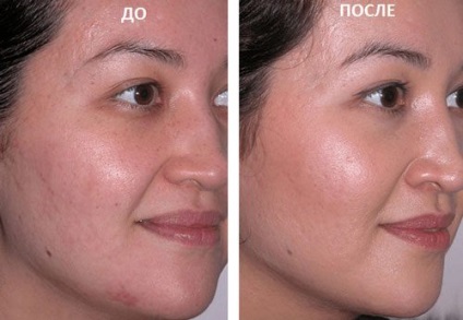 Felületi kémiai peeling arc véleménye, képek előtt és után (utána) Felületi kémiai peeling arc véleménye, fotók előtt és után