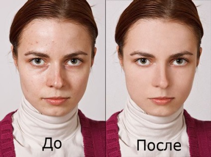 Felületi kémiai peeling arc véleménye, fotók előtt és után (kémiai) Felületi kémiai peeling arc véleménye, fotók előtt és után