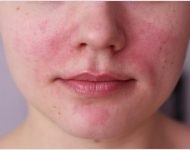 Felületi kémiai peeling arc véleménye, fotók előtt és után (a személy) Felületi kémiai peeling arc véleménye, fotók előtt és után