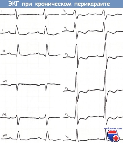 Jelek a pericarditis az EKG (jelek) Jelek a pericarditis az EKG