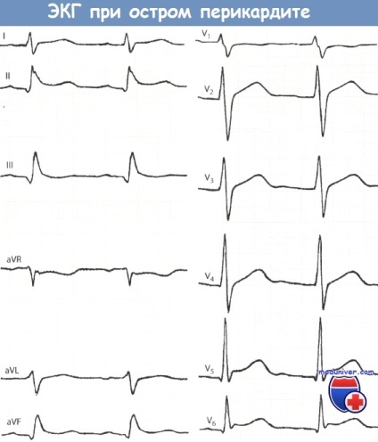 Pericarditis jelek EKG (emelkedő végtag fog) Jelek a pericarditis az EKG