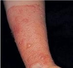 Egyszerű kontakt dermatitis - okai, tünetei, diagnózisa és kezelése