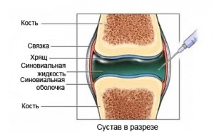 Protézisek szinoviális folyadék - készítmények hialuronsav