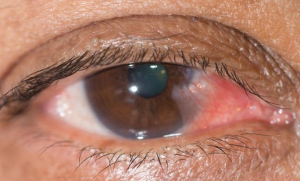 Pterygium szem és a hatékony kezelés (csepp és sebészi eltávolítása)