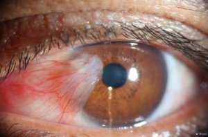 Pterygium betegség tünetei és kezelési módszerek