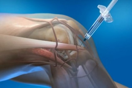 Törés a hátsó szarv medialis meniscus és az elülső laterialnogo károsodás mértékét és a kezelés