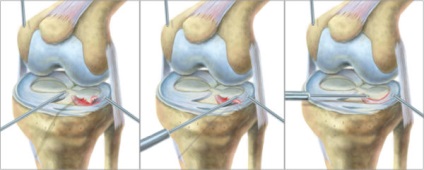 Törés a hátsó szarv medialis meniscus és az elülső laterialnogo károsodás mértékét és a kezelés