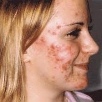 Receptek a rosacea kezelésére otthon