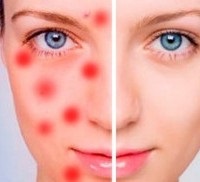 Receptek a rosacea kezelésére otthon