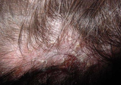 A szarkoidózis a bőr okoz, tünetek és a kezelés