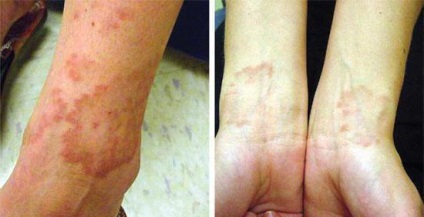 A szarkoidózis a bőr okoz, tünetek és a kezelés