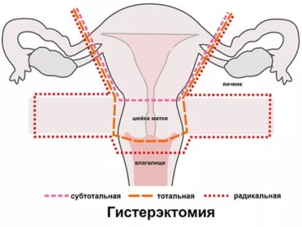 Mennyi ideig tart a műtéti eltávolítása a méh