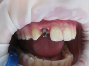 Az élettartam a fogászati implantátumok és milyen hatással van rá, árak, fotók (szolgáltatás) Az élettartam a fogászati implantátumok és milyen hatással van rá, árak, fotók