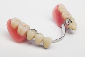 Az élettartam a fogászati implantátumok és milyen hatással van rá, árak, fotók (fogászati) Az élettartam a fogászati implantátumok és milyen hatással van rá, árak, fotók